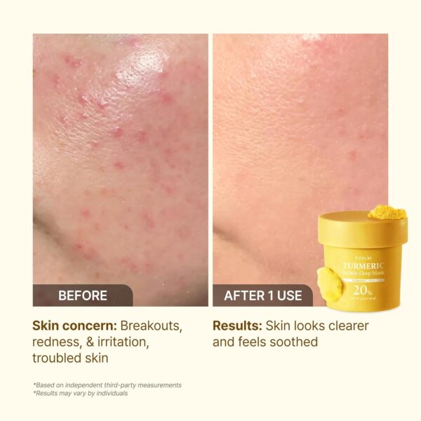 716NpY9YWAL._SL1500_ P.CALM Turmeric Bubble Deep Mask