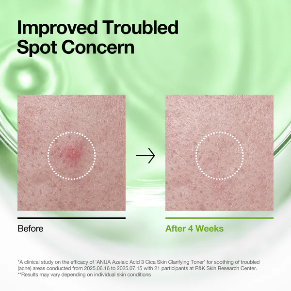 anua-us-toner-azelaic-3-cica-skin-clarifying-toner-1189970121 Anua Azelaic Acid 3 Cica Skin Clarifying Toner